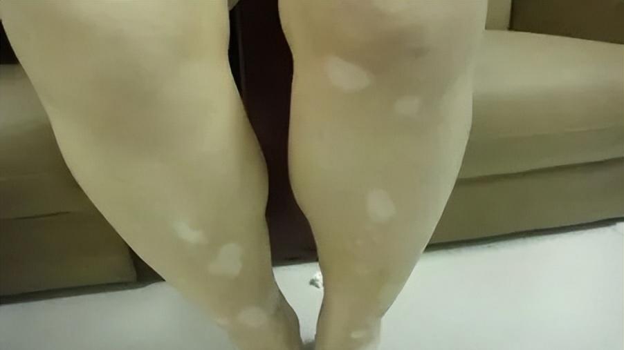 处暑|别跟风用药了！白癜风乱用药危害大，原因有3点