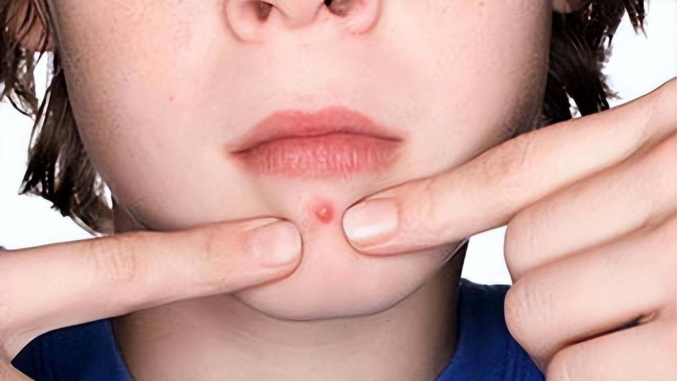 甲沟炎|上火，还怕冷？只需一味药，帮你打通中焦，将你的火气化为元气