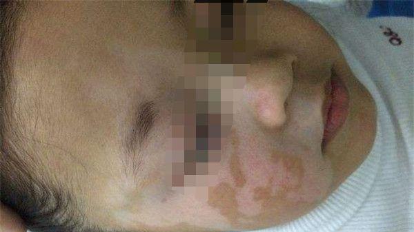 温阳|孩子得了白癜风，家长应该怎么办?