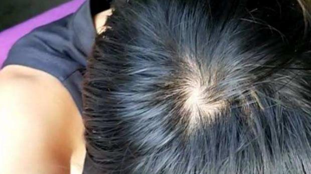 头皮屑 头发出油、头皮屑怎么根除？破解换季头皮的几大问题，头会臭都因洗发水挑错了！