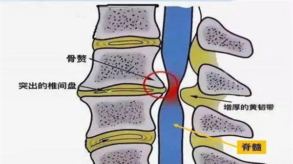 猕猴桃|椎间盘退变是怎么回事？可以避免吗？