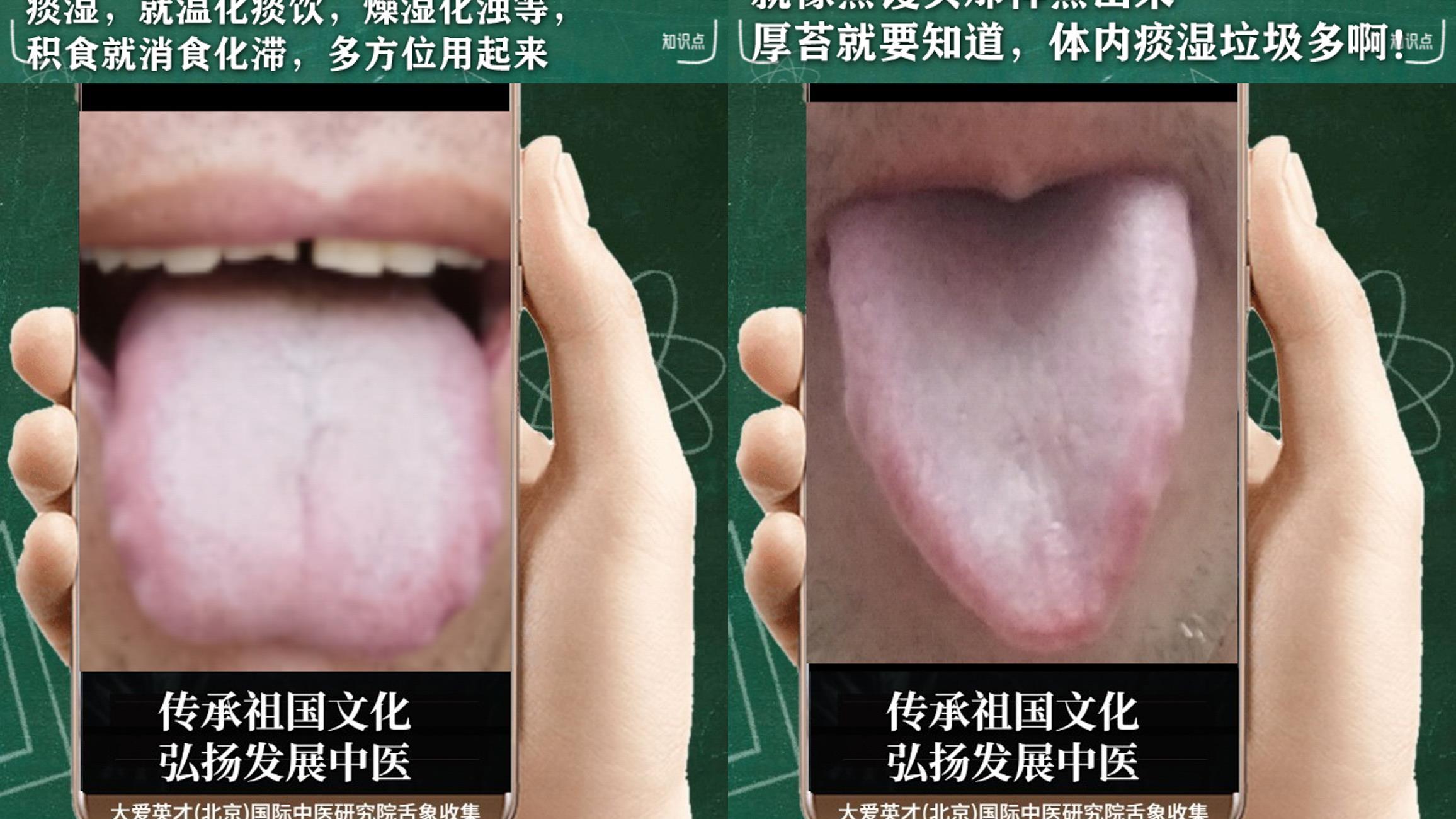 心律失常|反反复复胃胀气，心悸气短，便秘，脾胃不和的舌象案例讲解