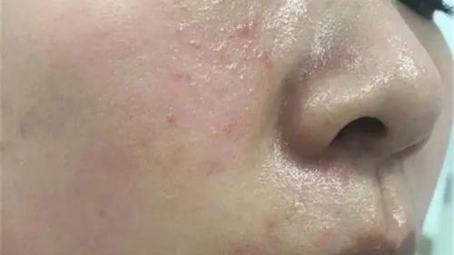 护肤品 如何快速修复敏感肌？千万别走了弯路而不自知！