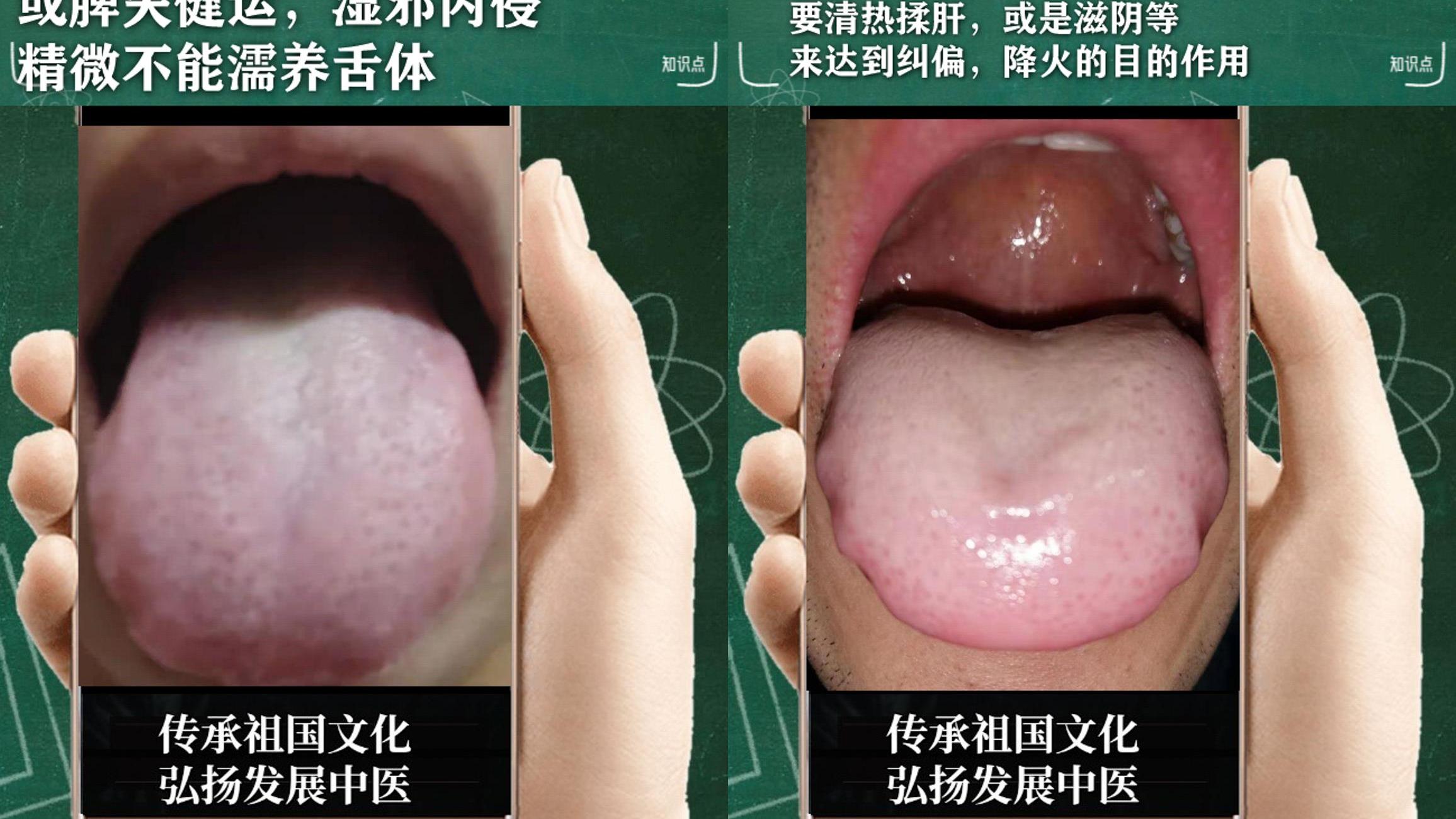 |中医分析：眼泡微浮，湿热下注，焦躁不安，经常反复很无奈