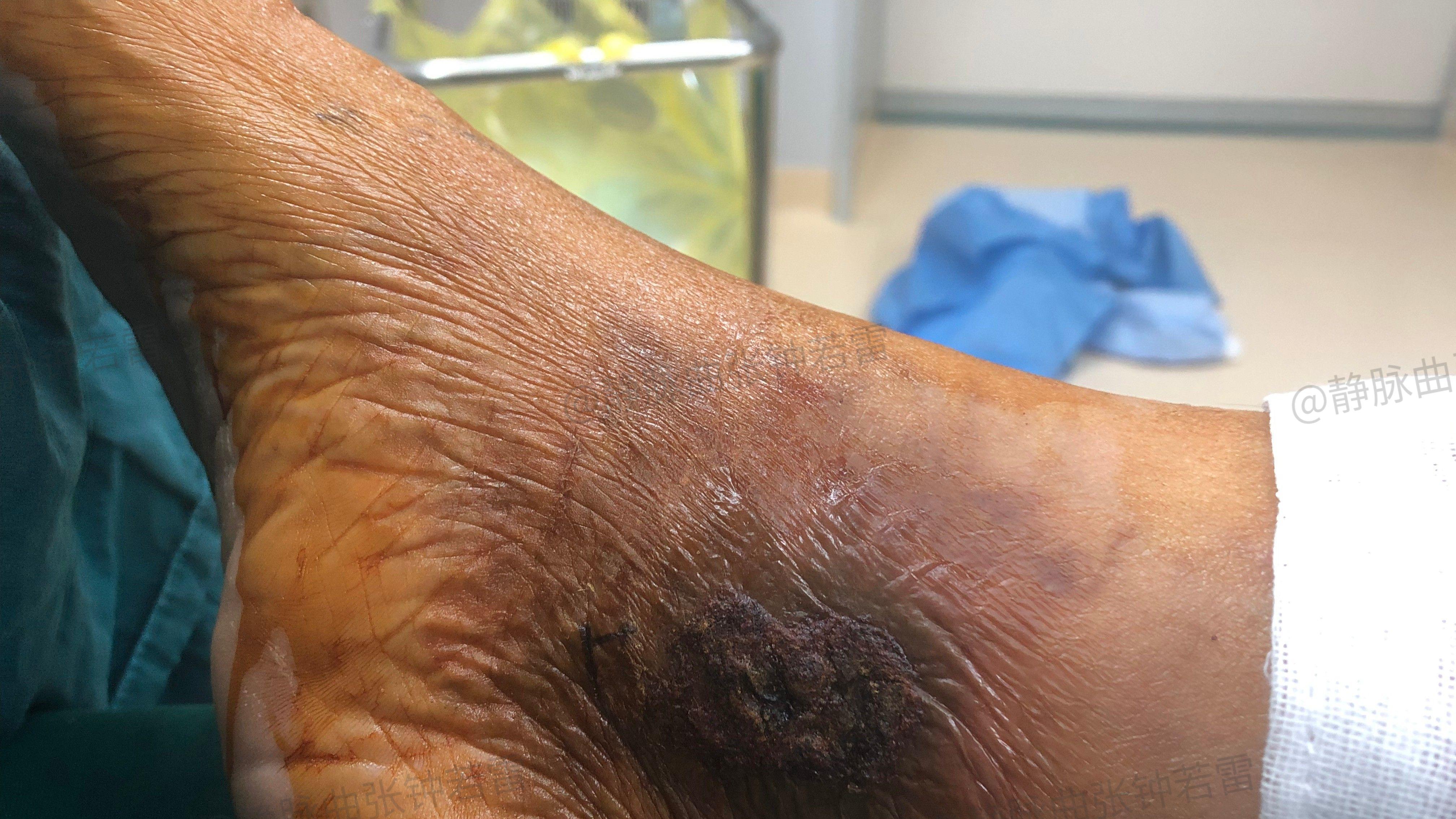 静脉曲张|老烂腿为什么脚老是肿，被静脉曲张困扰十五年的公交司机，背后的疼痛无人知晓！