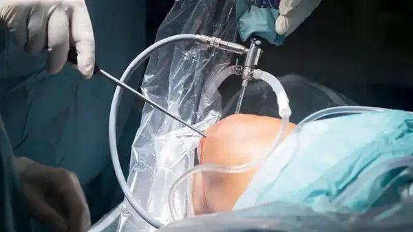 运动|骨关节炎如何避免关节置换的切肤之痛呢？