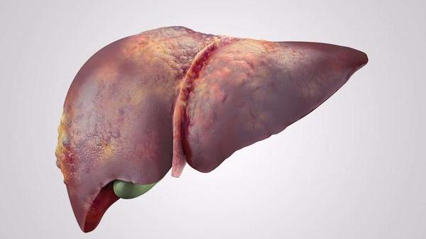 肝纤维化|什么是肝纤维化？它是否可逆？医生：对症治疗即可，别担心！