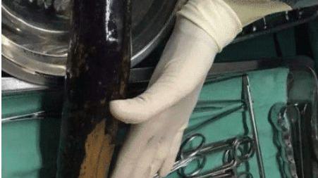 戒烟|突发悲剧！揪心！30厘米茄子快顶到心脏了，女子慌忙跑去医院就医，医生：怎么做到的