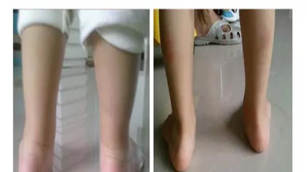 足外翻|足外翻是什么？足外翻能治吗？