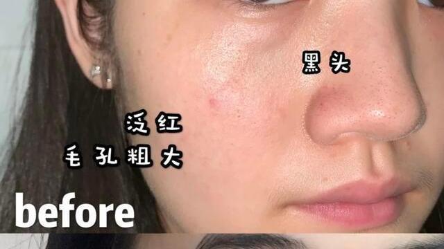 宋轶 昨天宋轶晒出的纯露火了，祛痘美白还补水，用完皮肤好到没朋友