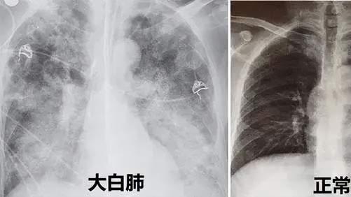白肺|既然是奥密克戎，怎么会形成“白肺”？