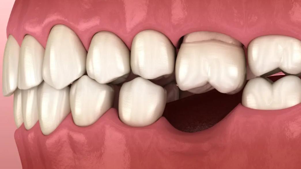 牙齿|镶牙疼不疼？