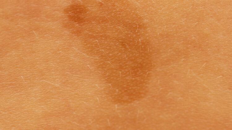 结直肠癌|为什么身上，经常青一块紫一块的？背后的2个原因终于找到了