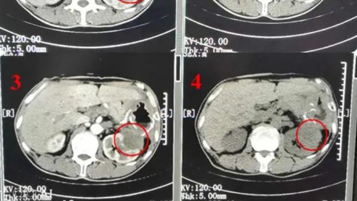 肿瘤|47岁男子癌症晚期，肿瘤竟然被“热死”，这是怎么回事？
