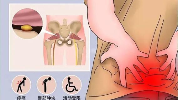 苹果|直乐大讲堂：久坐屁股痛，小心梨状肌综合征！