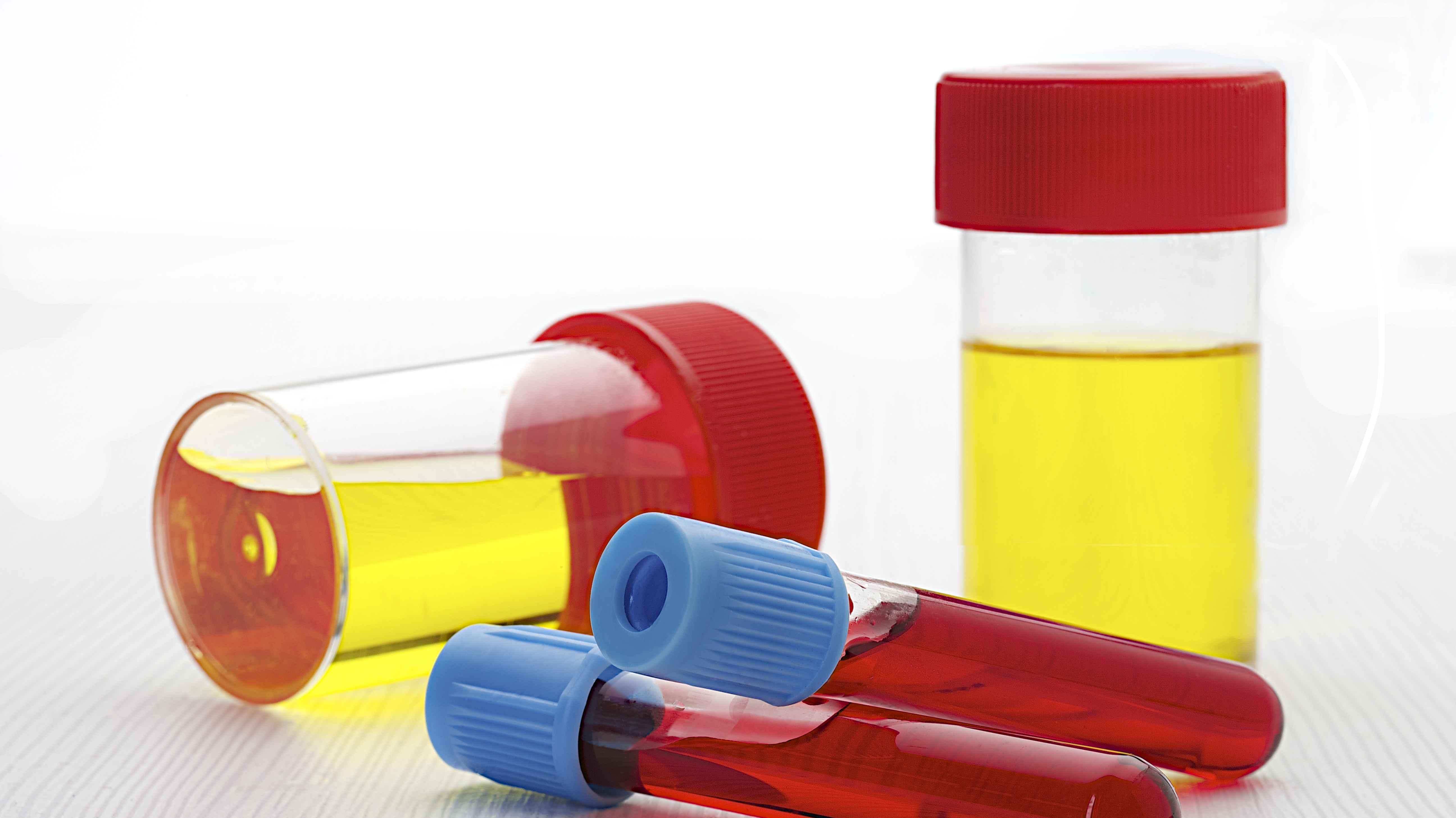 胆固醇|胆固醇偏高如何改善？提醒：除了运动，患者还应做到这几点！