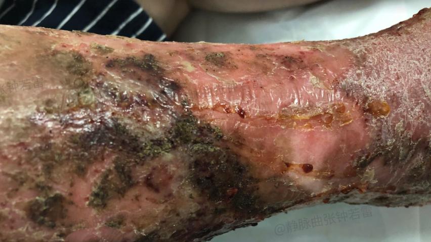 抑郁症|都21世纪了，还有人觉得老烂腿保不住，要“锯腿”？