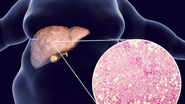 饮食|脂肪肝会引起肝硬化，研究发现可能与肠道菌群有关，7点来改善