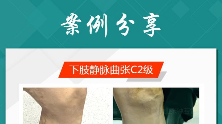 静脉曲张|蚯蚓腿小腿爆青筋是为何？六旬培训师小腿爆青筋，直呼跳舞难看想“换腿”！