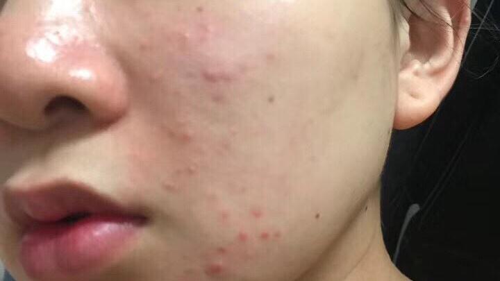 牛奶 关于油痘肌，我有话想说……