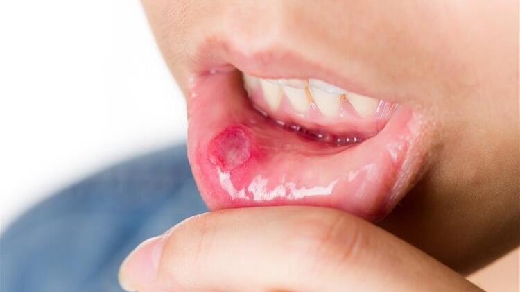 口腔溃疡|有一种痛，叫口腔溃疡：补充维C不管用，用上4类药物更靠谱