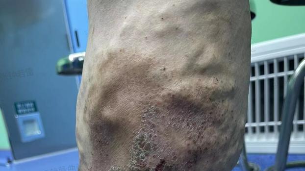 |10年前治疗的曲张静脉“卷土重来”，变本加厉，小腿变黑溃疡