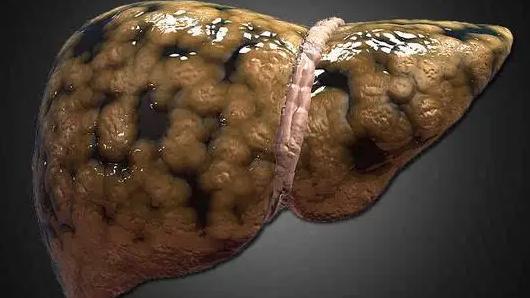 酒精肝|酒精肝检查项目有哪些？提醒：“酒精肝”将至，身体会发出3个“警报”