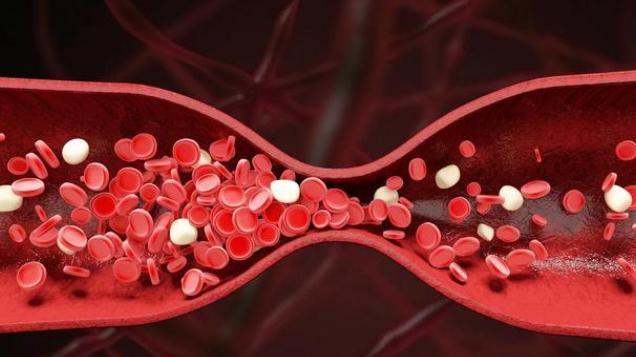 更年期|“血栓大户”被揪出，医生建议管住嘴，别等生病了才着急