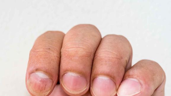 心绞痛|指甲表面出现“竖纹”？提醒：这多半与4个因素有关，别不当回事