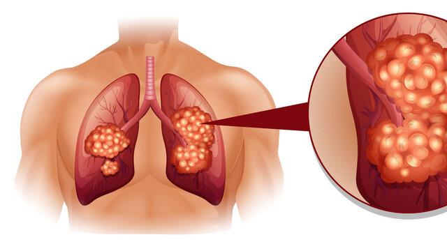 肿瘤|得了肺癌晚期，如今依然健康！他的5个康复秘诀，值得学习