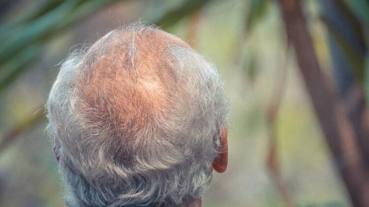 疾病|头皮里，老是长疙瘩和脓包，是怎么了？或是4种疾病信号，别大意