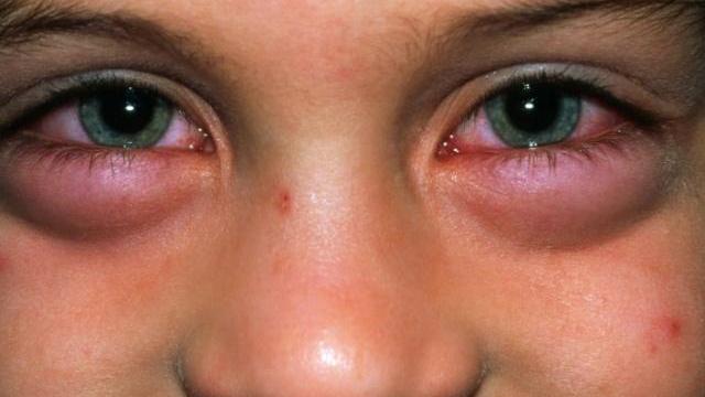 尿毒症|“尿毒症”来临前，身体可能会发生这3种标志，很多人都没察觉！