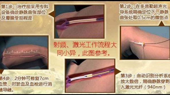 口腔健康|深度分析-----如何选择最“好”的静脉曲张手术？