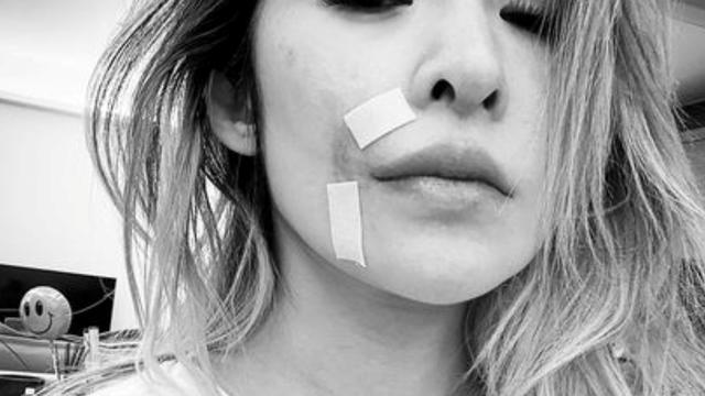 萧亚轩|萧亚轩自曝脸部缺一块肉！鼻子到嘴边伤疤明显，用化妆品疯狂遮盖