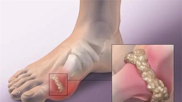 高血压|痛风性关节炎患者能喝酒吗？除禁酒外日常这些要注意