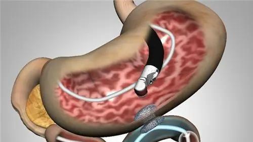 饮食|胃癌手术后饮食需要注意什么？吃什么营养品好