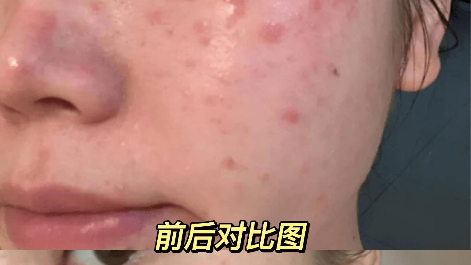 排毒|白折腾了！后悔没有早点知道这个去湿止痒法！竟然7天就可搞定湿疹