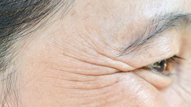 穴位|衰老的第一表现就是眼纹的出现，处理方式你选对了吗？