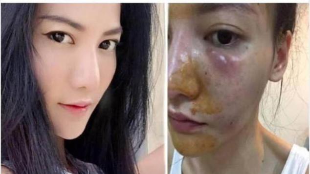 泰国女子连续打了6年“美白针”，如今的变化，网友直呼不可思议