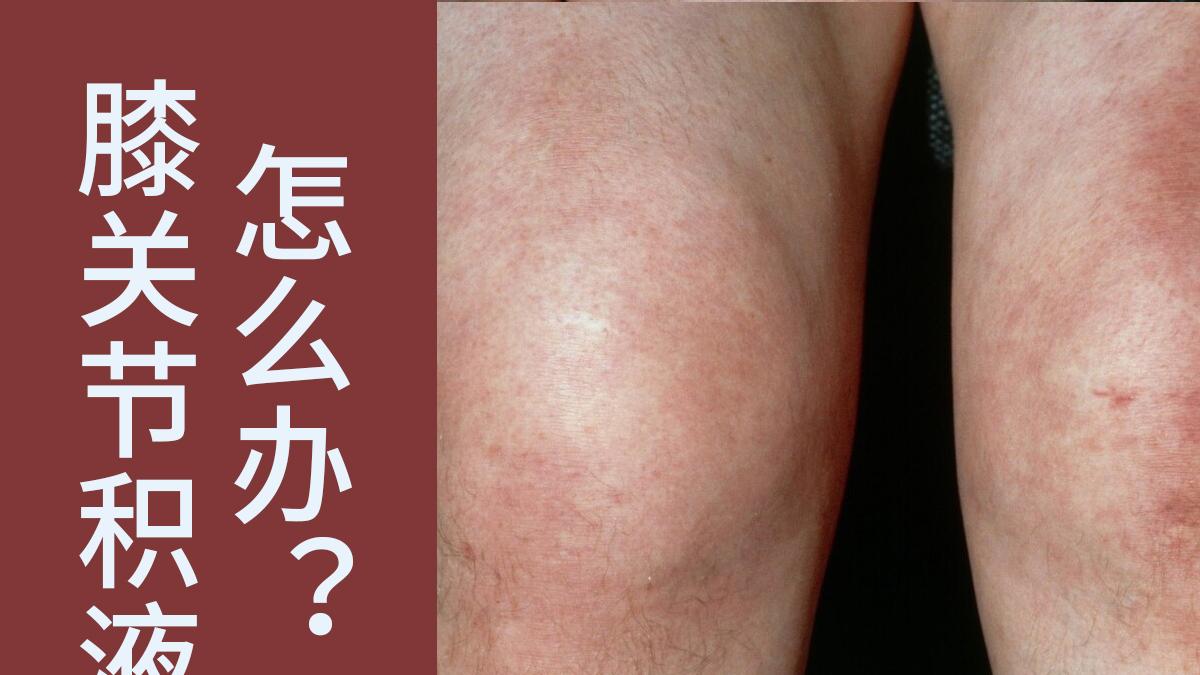 滑膜炎|得了滑膜炎应该怎么办？