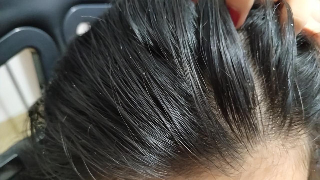 脱发|长期不用洗头发水，就可以长出更多的新发？脱发的人怎样做长头发