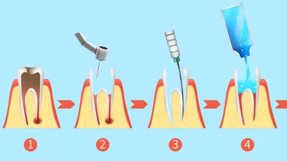 牙齿|根管治疗后，牙齿寿命是多久？