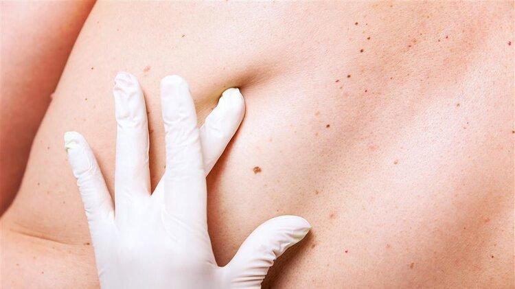 黑色素瘤|手臂上的痣超过11颗，患癌几率越大？4种方法教你找出“坏痣”