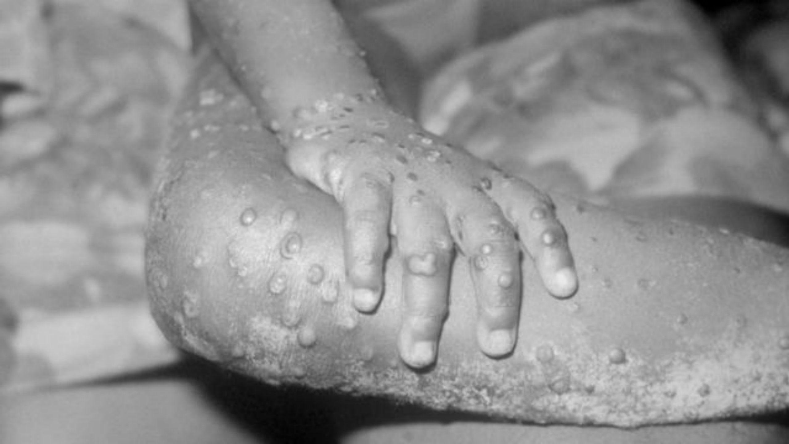 |什么是猴痘：症状、传播、防疫等你可能想了解的问题