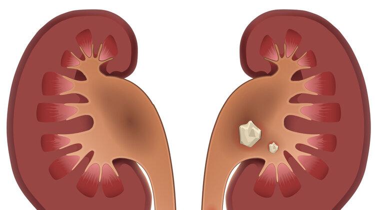 尿酸|尿酸高全身都受损，出现5种表现，可能是你尿酸高了，及时控制
