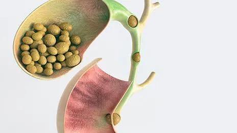 胆结石|之前都是保胆取石，为何现在查出胆结石，要切除胆囊？进来了解下