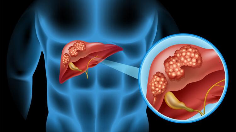 肝癌|年仅27岁，女护士查出肝癌晚期，患癌后2个反思，要引以为戒
