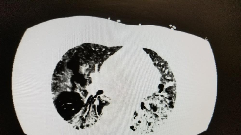 维生素C|重度肺气肿现在戒烟，还有救吗？病情能恢复吗？