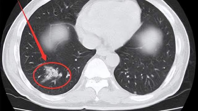 感冒|肌酐从287降到96，肾友得了这种「怪病」