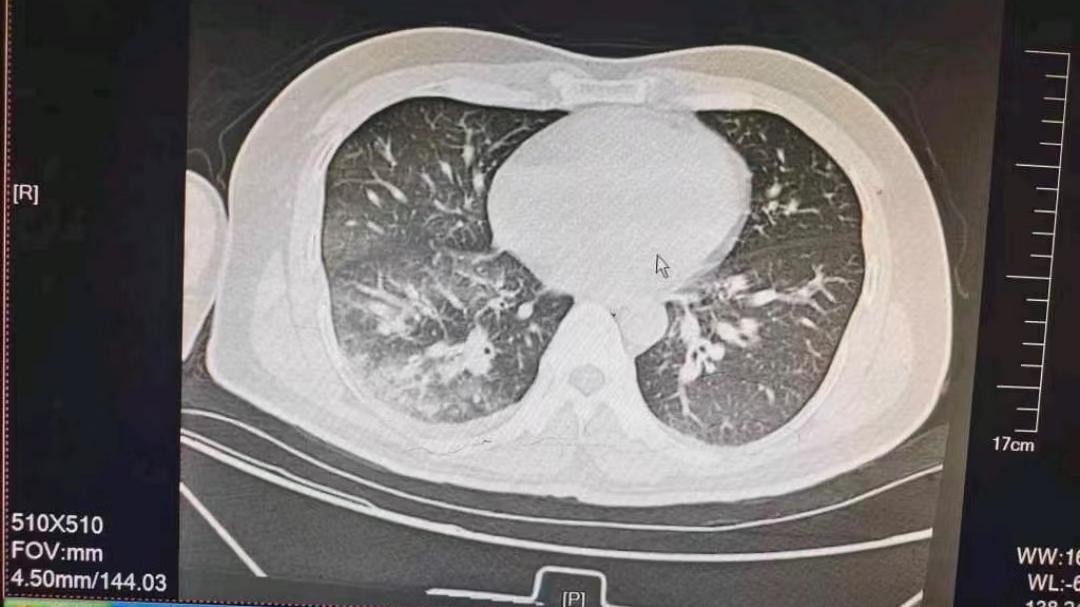 输液|人静脉内注射多少空气会导致死亡，来看看这个真实案例，切忌模仿